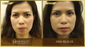 Hình ảnh cắt mí trước sau Dr Hải Lê - Ca 26