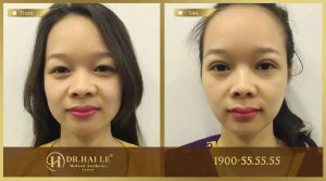 Hình ảnh cắt mí trước sau Dr Hải Lê - Ca 27
