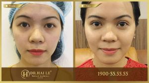 Hình ảnh cắt mí trước sau Dr Hải Lê - Ca 28