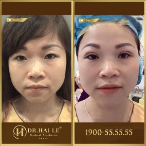Hình ảnh cắt mí trước sau Dr Hải Lê - Ca 3