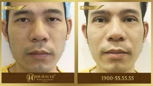 Hình ảnh cắt mí trước sau Dr Hải Lê - Ca 32