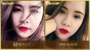 Hình ảnh cắt mí trước sau Dr Hải Lê - Ca 34