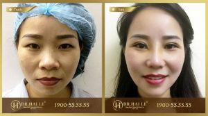Hình ảnh cắt mí trước sau Dr Hải Lê - Ca 35
