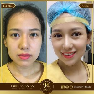 Hình ảnh cắt mí trước sau Dr Hải Lê - Ca 36