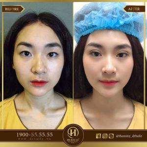 Hình ảnh cắt mí trước sau Dr Hải Lê - Ca 38