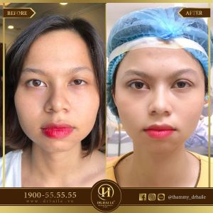 Hình ảnh cắt mí trước sau Dr Hải Lê - Ca 39