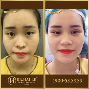 Hình ảnh cắt mí trước sau Dr Hải Lê - Ca 4