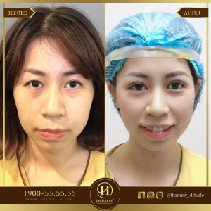 Hình ảnh cắt mí trước sau Dr Hải Lê - Ca 40