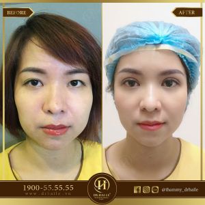 Hình ảnh cắt mí trước sau Dr Hải Lê - Ca 41