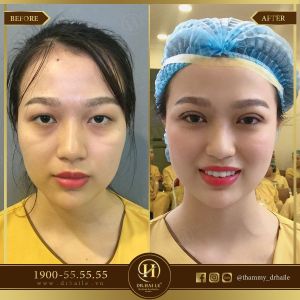 Hình ảnh cắt mí trước sau Dr Hải Lê - Ca 42