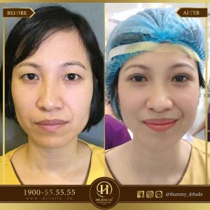 Hình ảnh cắt mí trước sau Dr Hải Lê - Ca 43