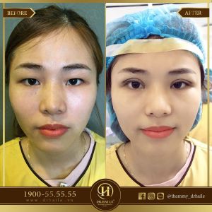Hình ảnh cắt mí trước sau Dr Hải Lê - Ca 44
