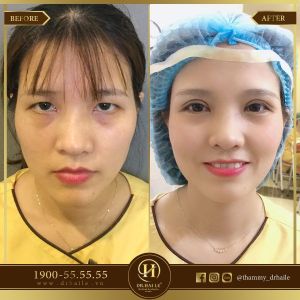 Hình ảnh cắt mí trước sau Dr Hải Lê - Ca 45
