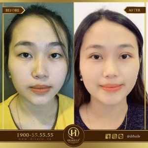 Hình ảnh cắt mí trước sau Dr Hải Lê - Ca 47