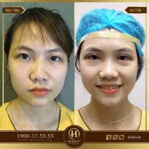 Hình ảnh cắt mí trước sau Dr Hải Lê - Ca 48