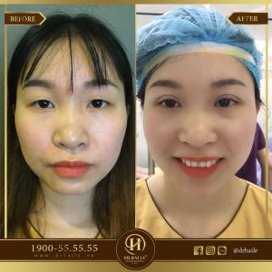 Hình ảnh cắt mí trước sau Dr Hải Lê - Ca 49