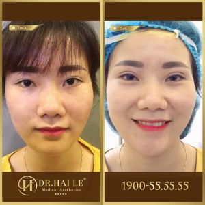 Hình ảnh cắt mí trước sau Dr Hải Lê - Ca 5