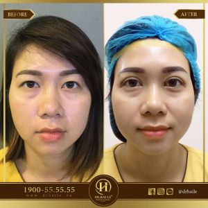 Hình ảnh cắt mí trước sau Dr Hải Lê - Ca 51