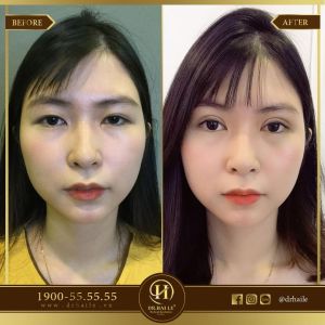 Hình ảnh cắt mí trước sau Dr Hải Lê - Ca 52
