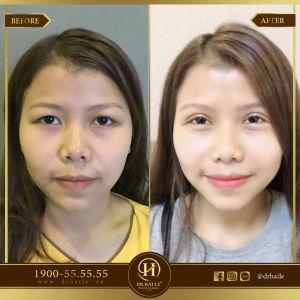 Hình ảnh cắt mí trước sau Dr Hải Lê - Ca 53