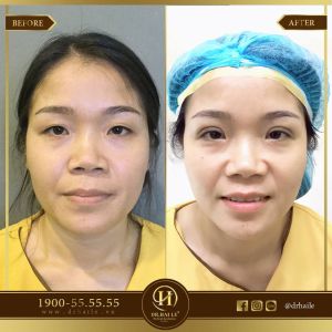 Hình ảnh cắt mí trước sau Dr Hải Lê - Ca 56