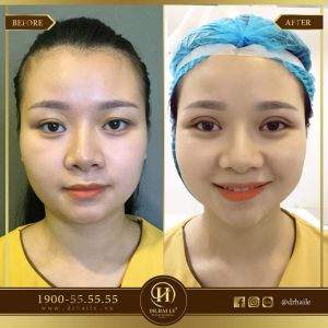 Hình ảnh cắt mí trước sau Dr Hải Lê - Ca 57