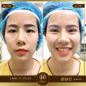 Hình ảnh cắt mí trước sau Dr Hải Lê - Ca 58