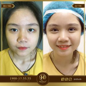 Hình ảnh cắt mí trước sau Dr Hải Lê - Ca 62