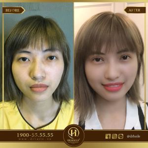 Hình ảnh cắt mí trước sau Dr Hải Lê - Ca 64