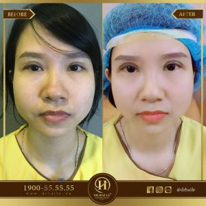 Hình ảnh cắt mí trước sau Dr Hải Lê - Ca 65
