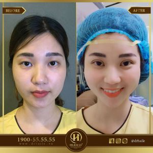 Hình ảnh cắt mí trước sau Dr Hải Lê - Ca 66