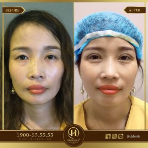 Hình ảnh cắt mí trước sau Dr Hải Lê - Ca 67