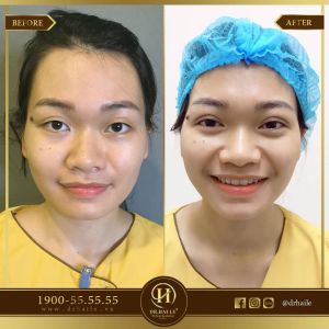 Hình ảnh cắt mí trước sau Dr Hải Lê - Ca 68