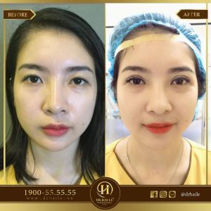 Hình ảnh cắt mí trước sau Dr Hải Lê - Ca 71