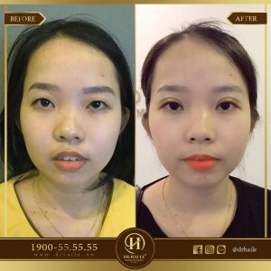 Hình ảnh cắt mí trước sau Dr Hải Lê - Ca 79