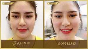 Hình ảnh cắt mí trước sau Dr Hải Lê - Ca 8