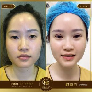 Hình ảnh cắt mí trước sau Dr Hải Lê - Ca 95