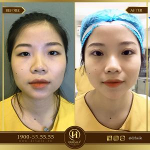 Hình ảnh cắt mí trước sau Dr Hải Lê - Ca 99