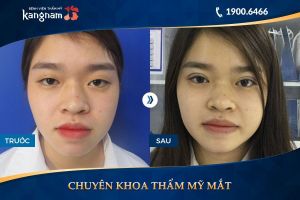 Hình ảnh cắt mí trước sau thẩm mỹ Kangnam - Ca 1