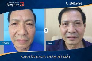 Hình ảnh cắt mí trước sau thẩm mỹ Kangnam - Ca 10