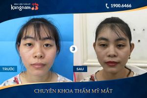 Hình ảnh cắt mí trước sau thẩm mỹ Kangnam - Ca 11