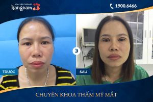Hình ảnh cắt mí trước sau thẩm mỹ Kangnam - Ca 12