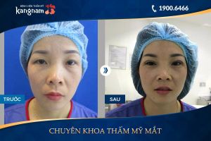 Hình ảnh cắt mí trước sau thẩm mỹ Kangnam - Ca 13