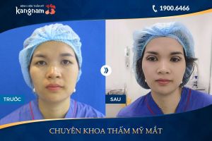 Hình ảnh cắt mí trước sau thẩm mỹ Kangnam - Ca 14