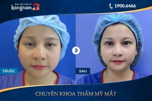 Hình ảnh cắt mí trước sau thẩm mỹ Kangnam - Ca 15