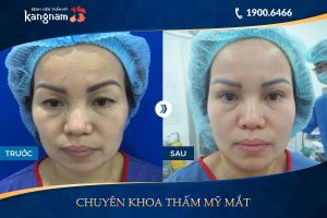 Hình ảnh cắt mí trước sau thẩm mỹ Kangnam - Ca 16
