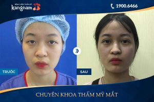Hình ảnh cắt mí trước sau thẩm mỹ Kangnam - Ca 17
