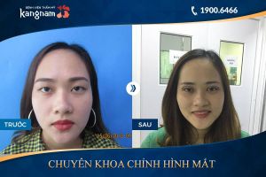 Hình ảnh cắt mí trước sau thẩm mỹ Kangnam - Ca 18