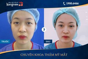 Hình ảnh cắt mí trước sau thẩm mỹ Kangnam - Ca 19