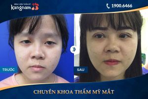 Hình ảnh cắt mí trước sau thẩm mỹ Kangnam - Ca 2